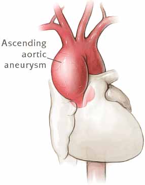 Ascending aortic aneurysm