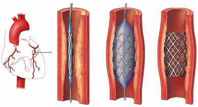 stent stenting coronary artery heart cardiac disease angioplasty placement cad medical part genetic inflammatory caused diseases link nucleus copyright inc