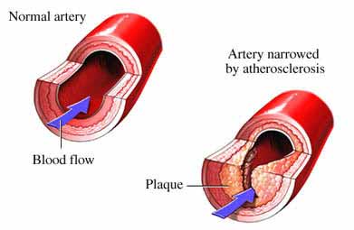 Normal artery compared to artery by atherosclerosis