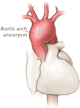 aortic arch aneurysm