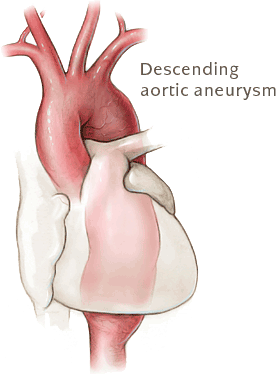 descending aortic aneurysm