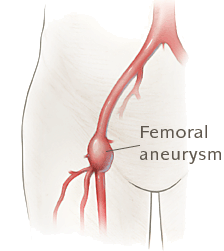 femoral aneurysm
