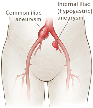 illiac aneurysm