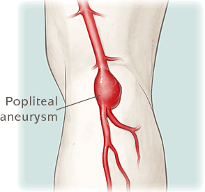 popliteal aneurysm