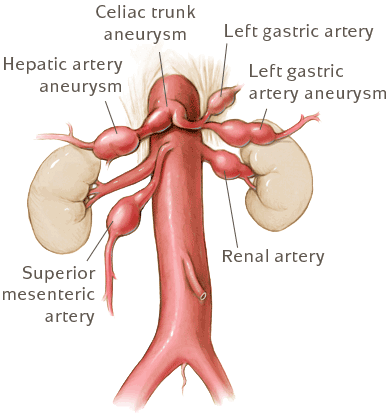visceral aneurysm