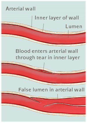 arterial wall diagram