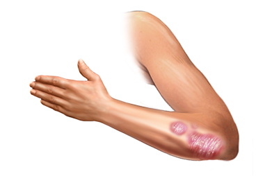 psoriasis on the arm