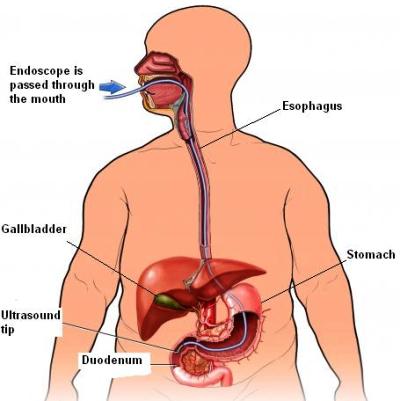 diagram of endoscope passed through digestive system