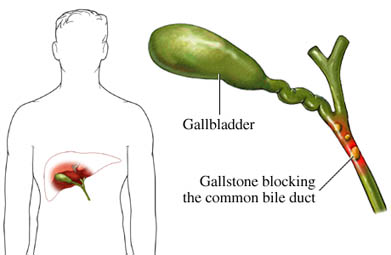 gallstones in the gallbladder