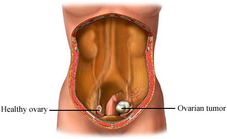 ovarian tumor illustration
