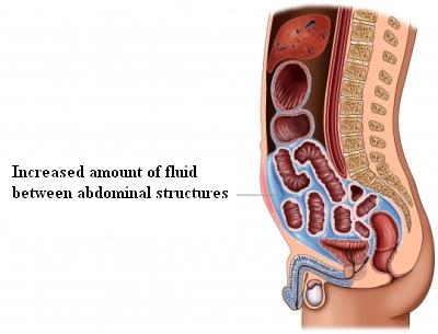 fluid between abdominal structures