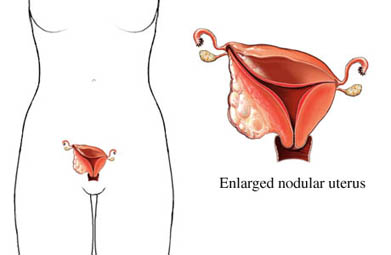 enlarged nodular uterus