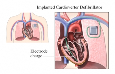 implanted cardioverter defribillator