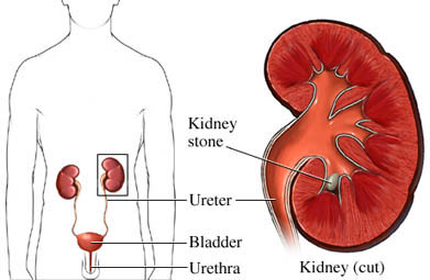 kidney stone diagram of kidney