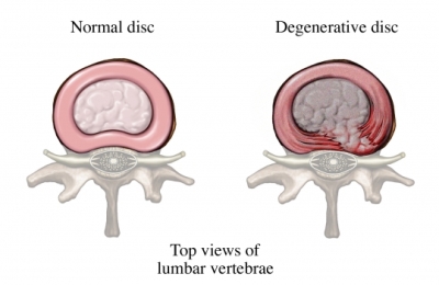 lumbar vertebrae normal disc and degenerative disc
