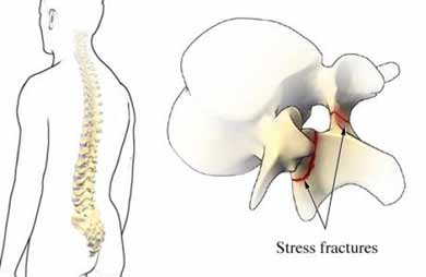 spondylolysis stress fractures
