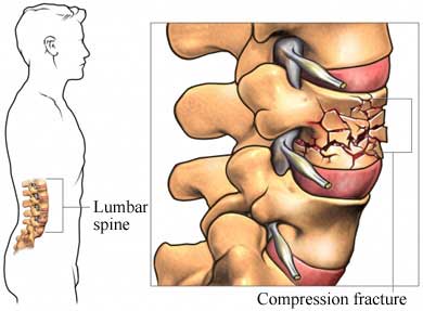 compression fracture of the spine