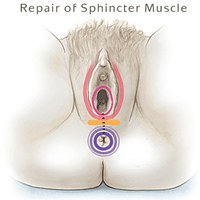 repair of sphincter muscle