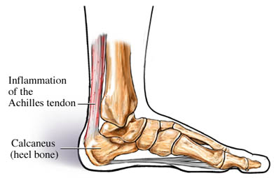 inflammation of the achilles tendon