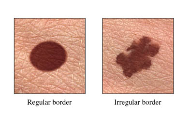 skin cancer identifying moles