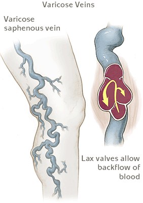 diagram of varicose veins