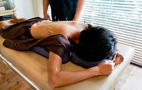 woman getting acupuncture at uva health for joint pain