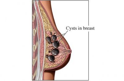 cysts in breast diagram